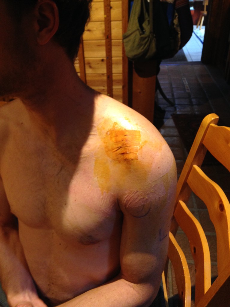 Jared's shoulder 5-10-15
